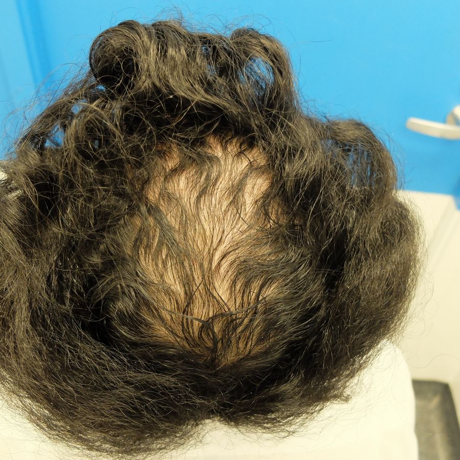 Finasteride Gel Precio