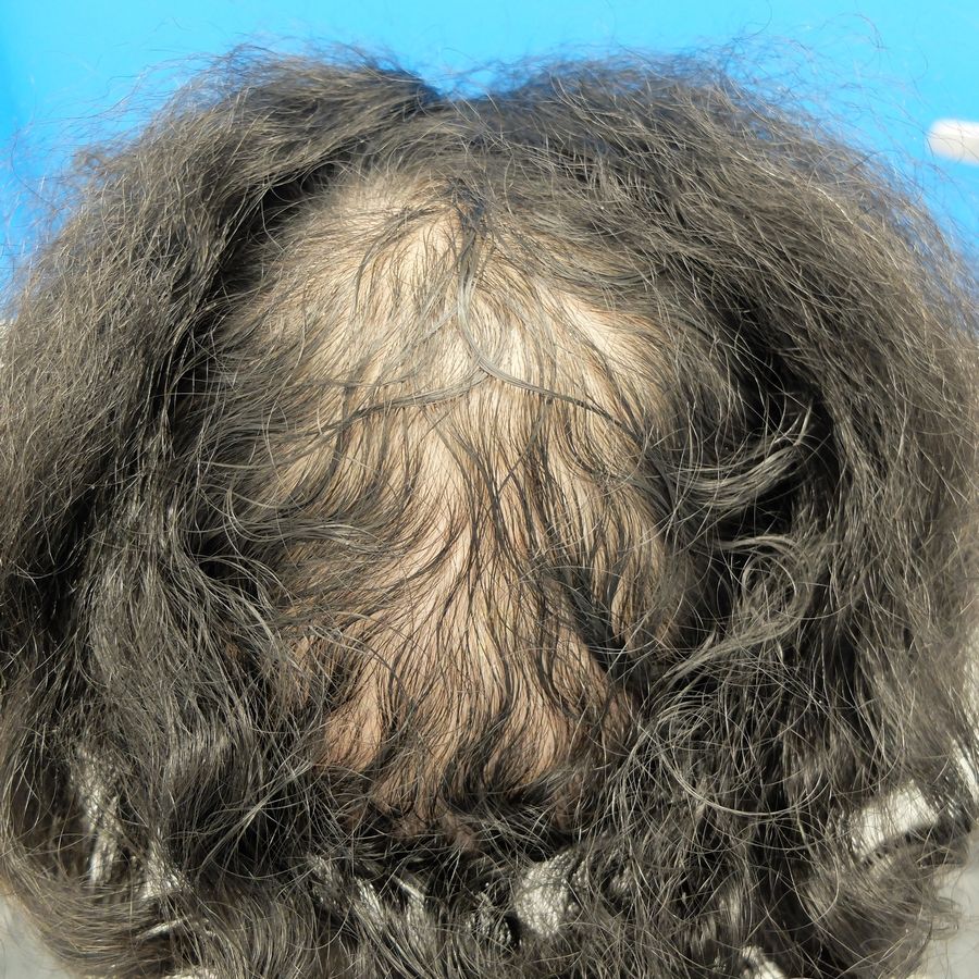 finasteride gel precio